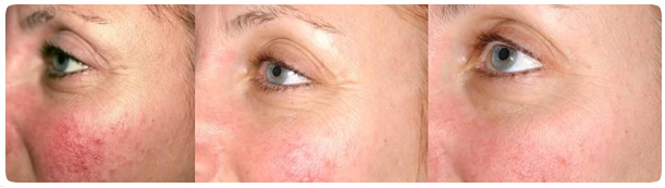 Los Angeles Laser Skin Rejuvenation