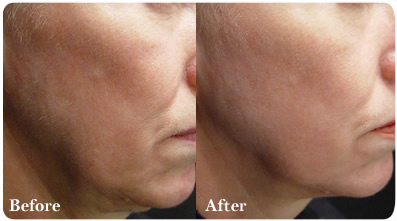Los Angeles Laser Skin Rejuvenation